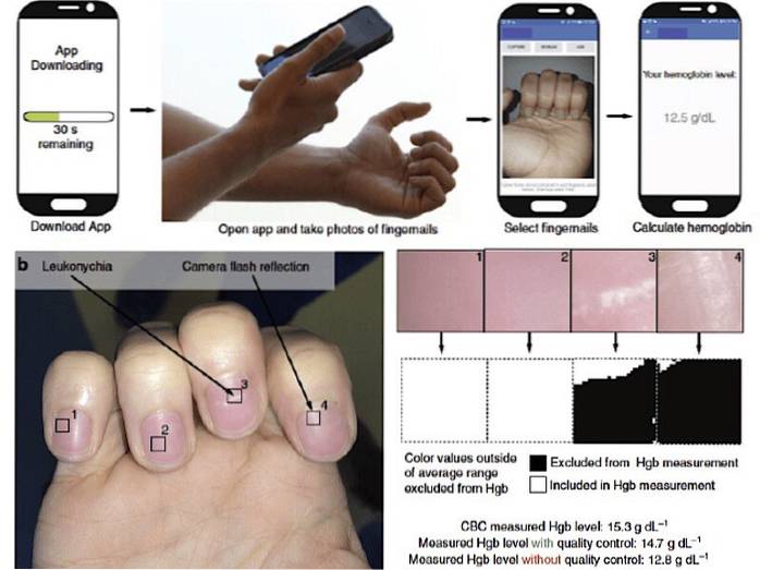New Mobile App Will Detect Anemia with Just Your Fingernails